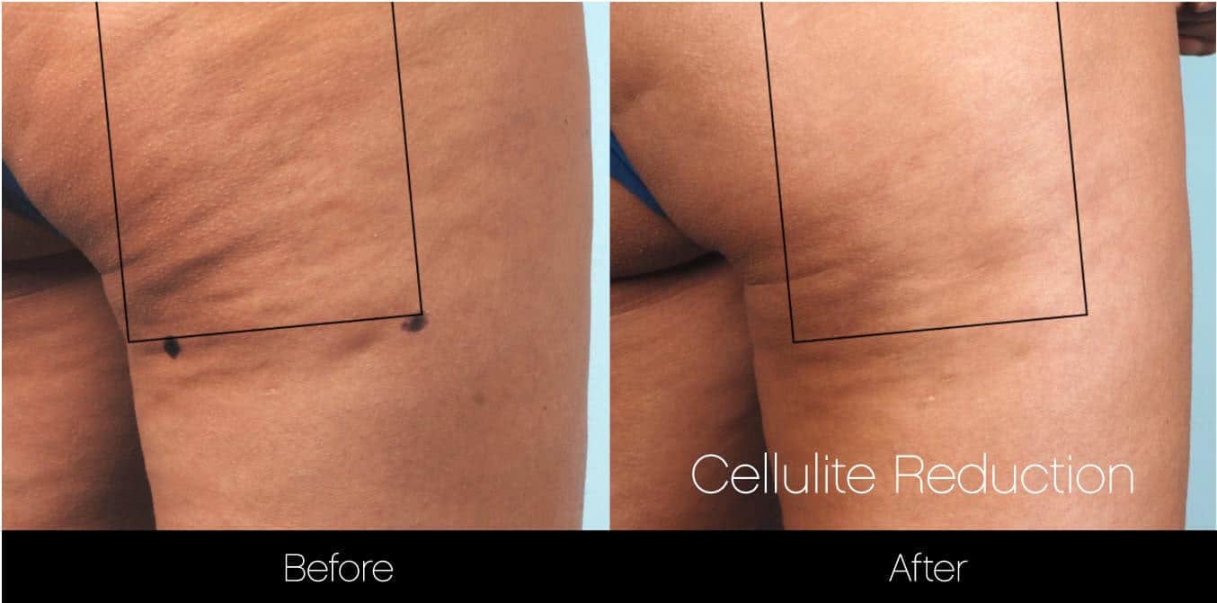 Cellulite Reduction Before and After Gallery – Photo 16