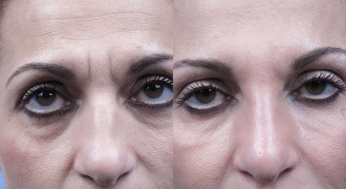Fractional CO2 Laser Before and After Gallery – Photo 53