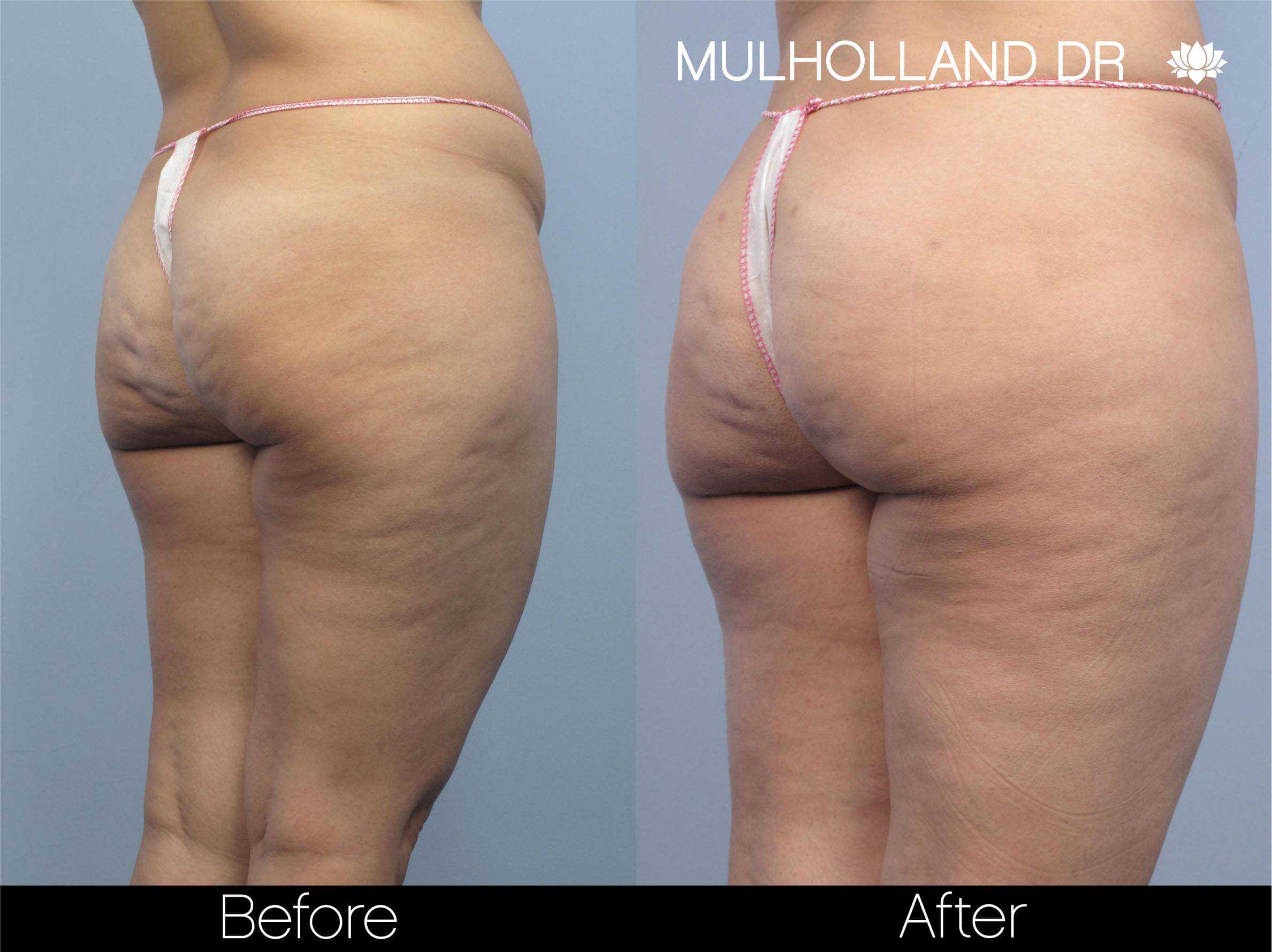 Cellulite Reduction Before and After Gallery – Photo 48