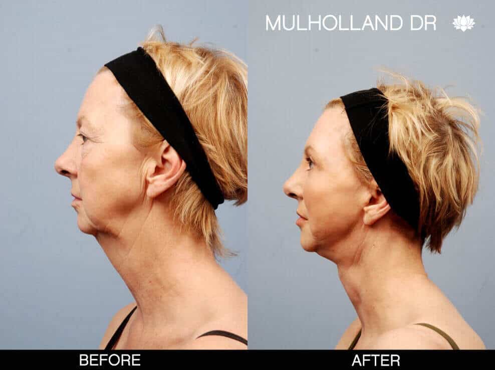 FaceTite Before and After Gallery – Photo 27