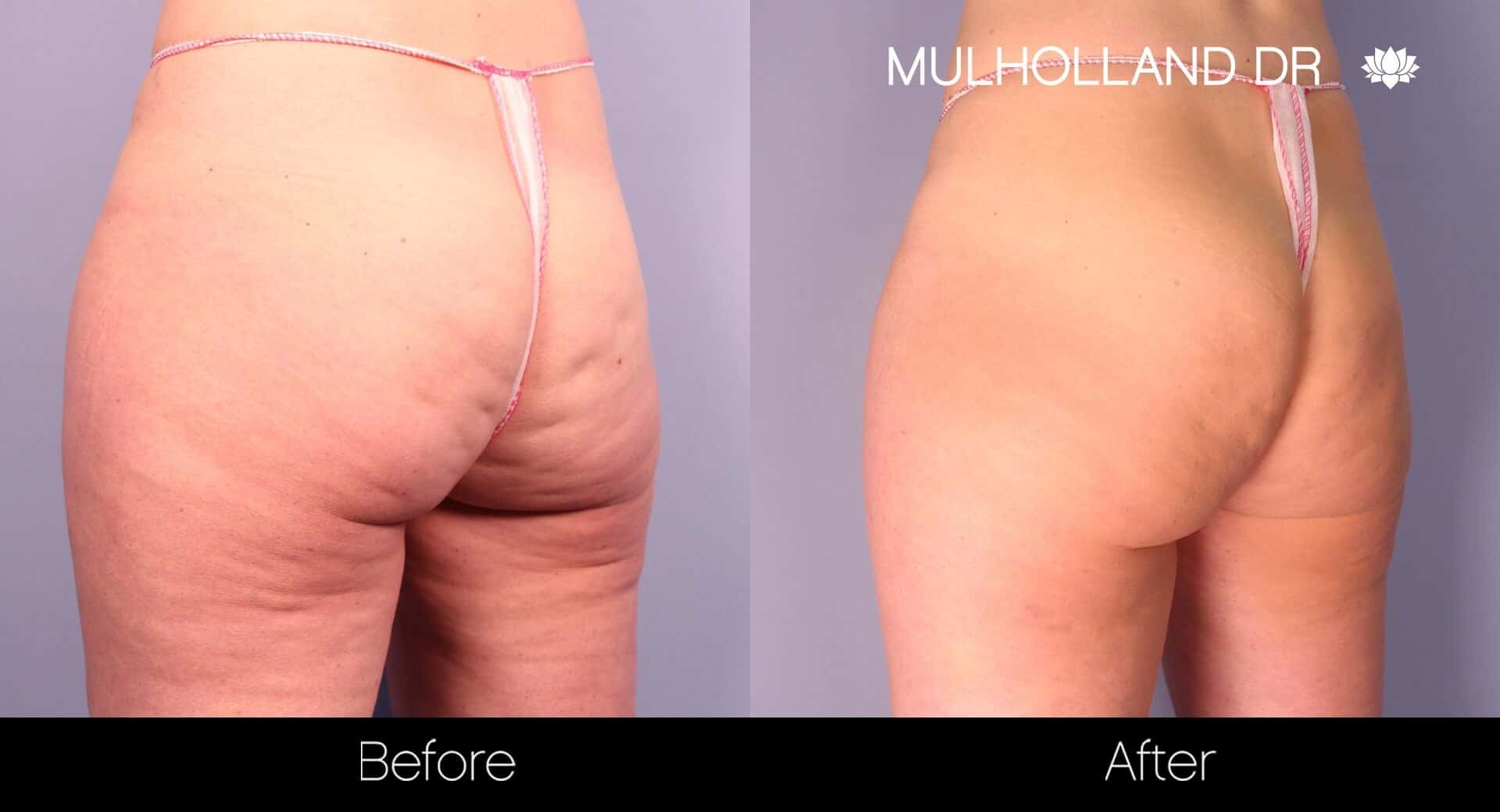 Cellfina Cellulite Treatment - Before and After Gallery – Photo 2