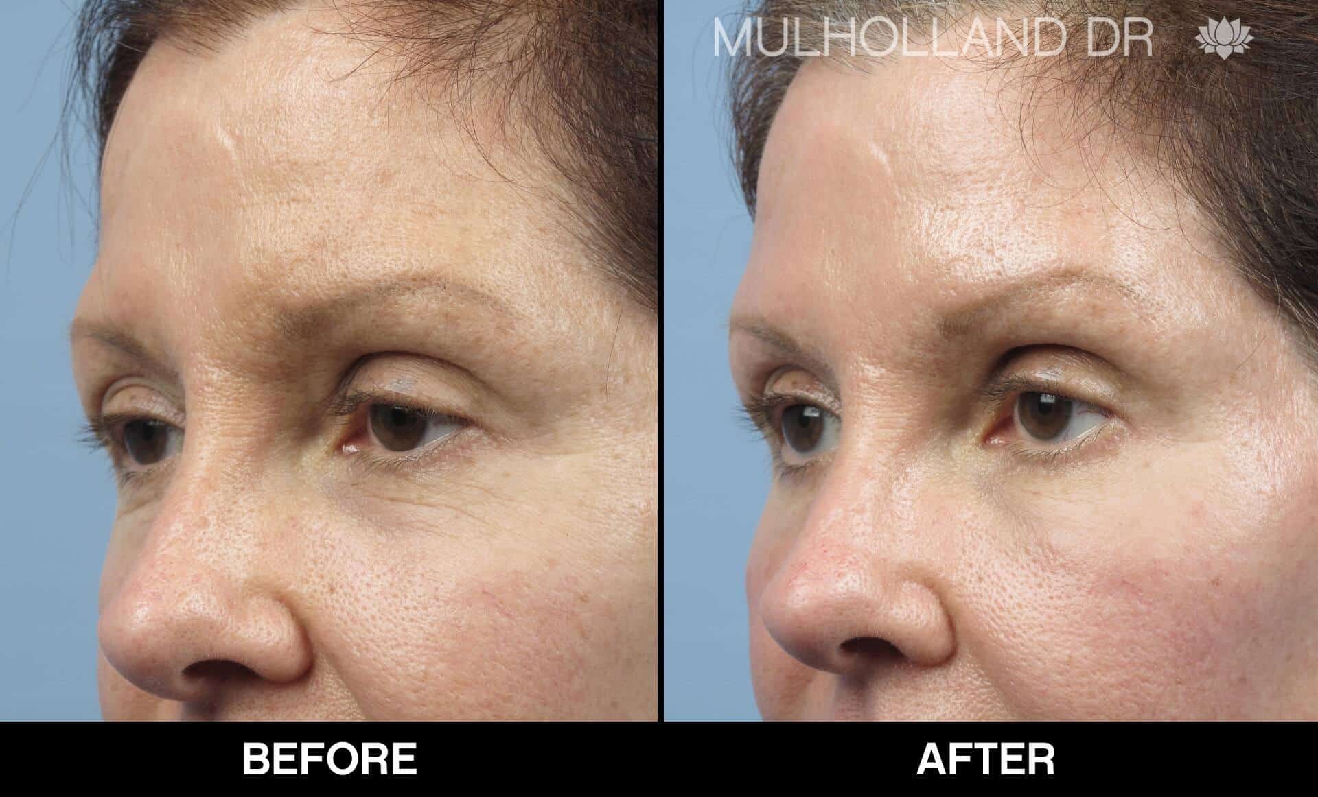Dermal Fillers Before and After Gallery – Photo 142