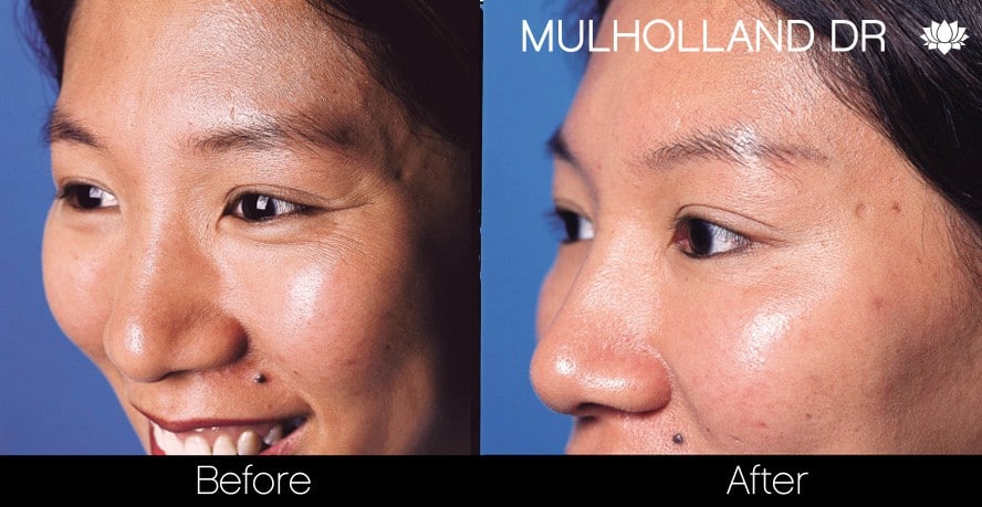 Botox Before and After Gallery - Photo 17
