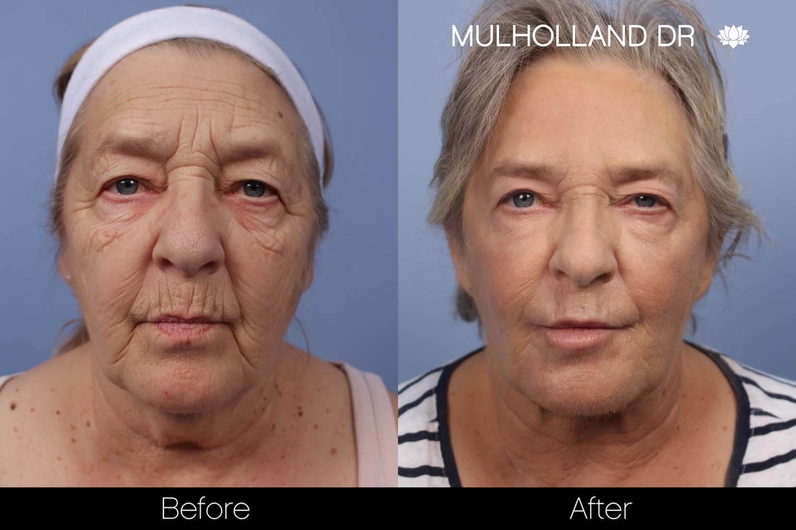FaceTite Before and After Gallery – Photo 9