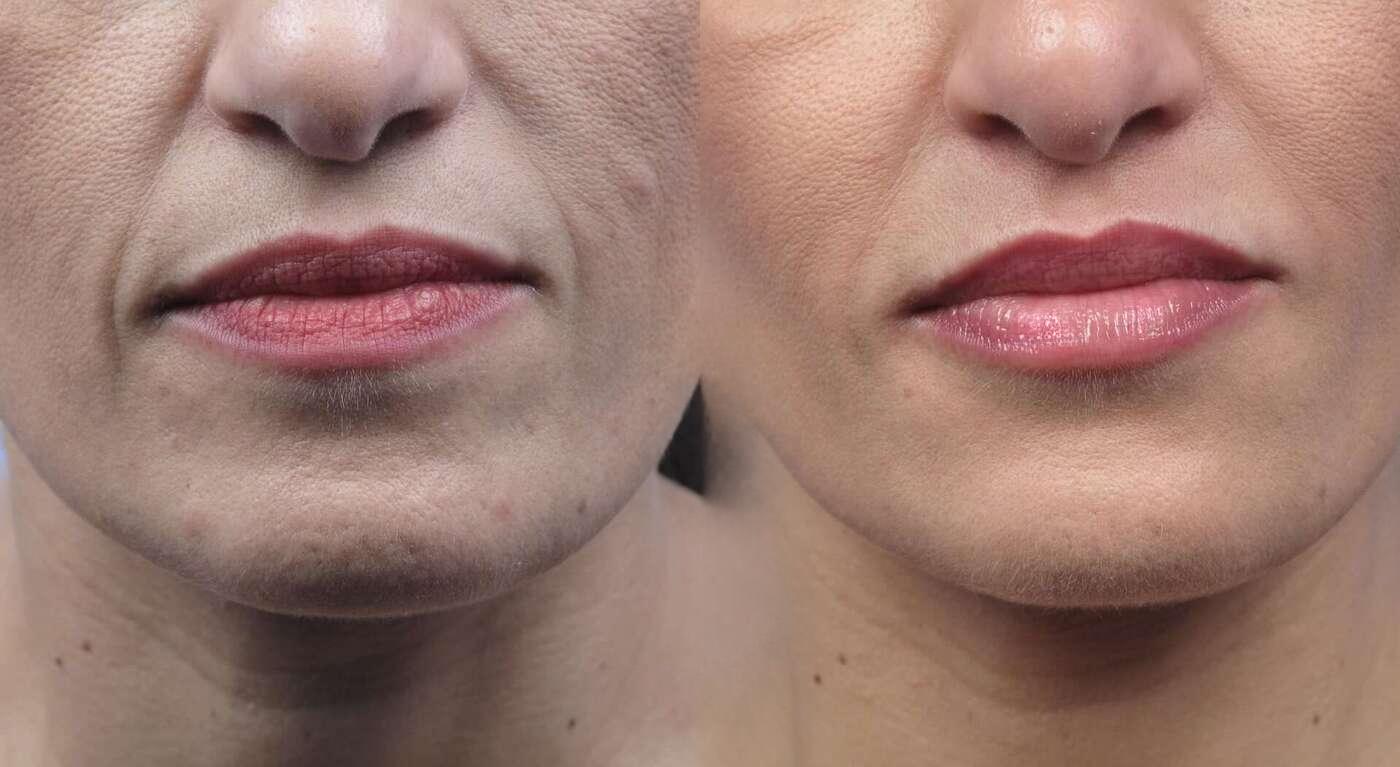 Fractional CO2 Laser Before and After Gallery – Photo 52
