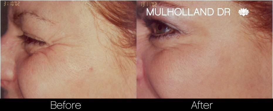 Botox Before and After Gallery - Photo 22