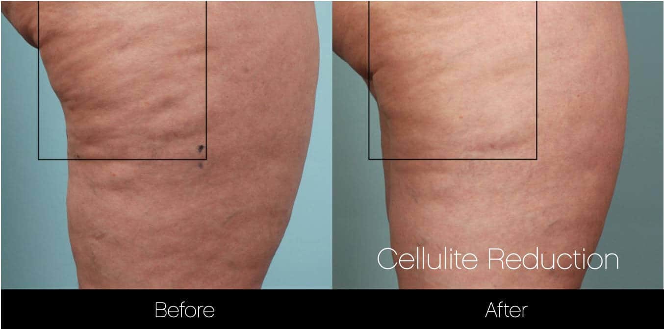 Cellulite Reduction Before and After Gallery – Photo 14