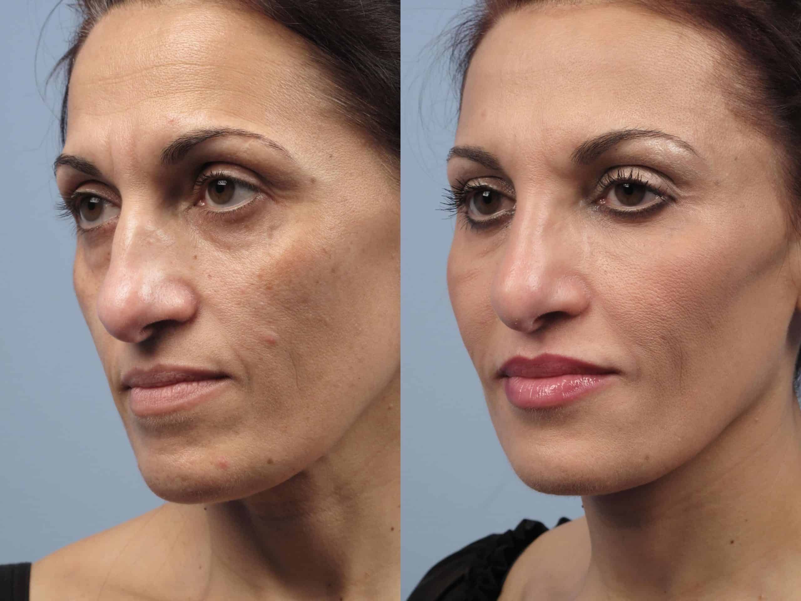 Fractional Co2 Laser - Patient 2 - Spamedica