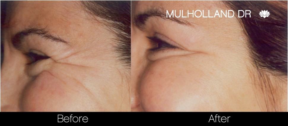 Botox Before and After Gallery - Photo 23