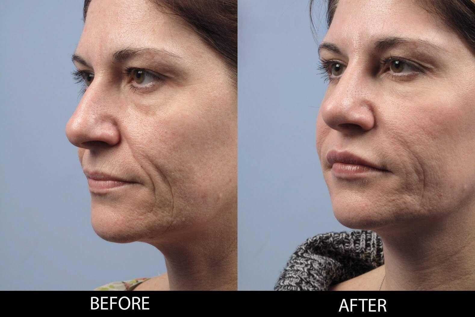 Dermal Fillers Before and After Gallery – Photo 123