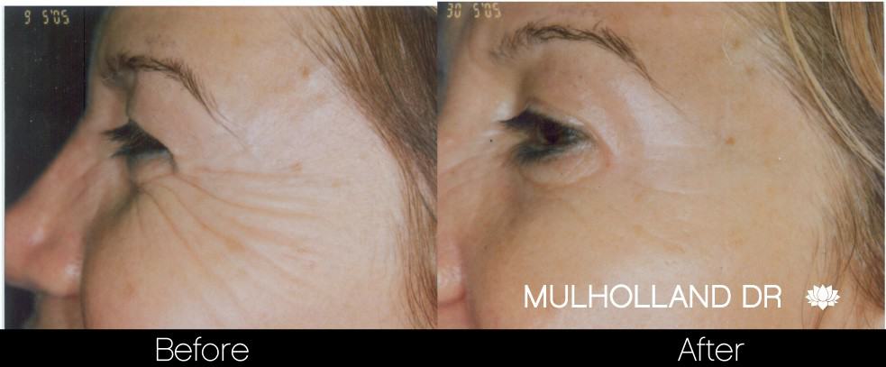 Botox Before and After Gallery - Photo 24