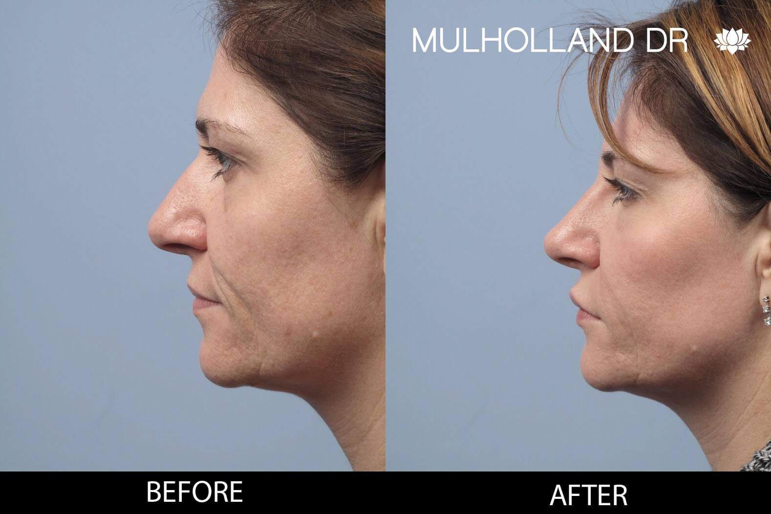 Dermal Fillers Before and After Gallery – Photo 122