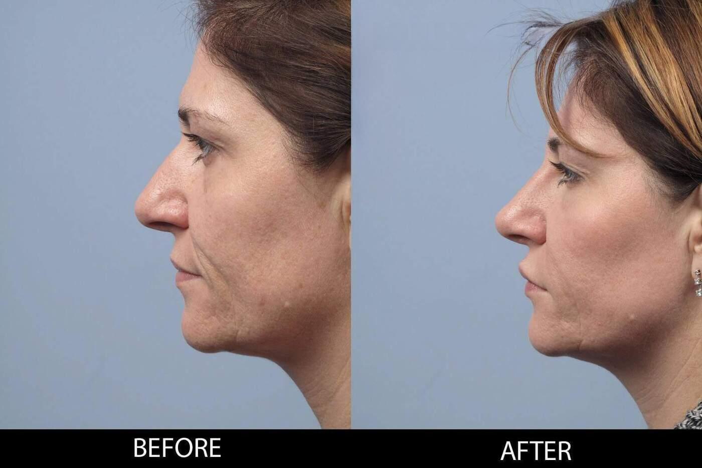 Dermal Fillers Before and After Gallery – Photo 122