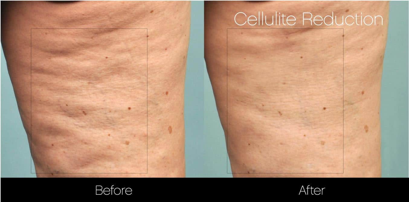Cellulite Reduction Before and After Gallery – Photo 12