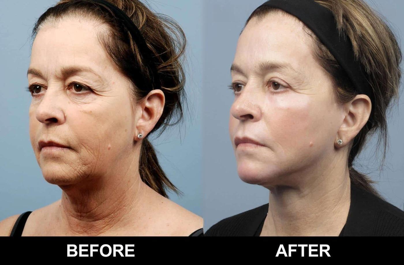 Fractional CO2 Laser Before and After Gallery – Photo 49