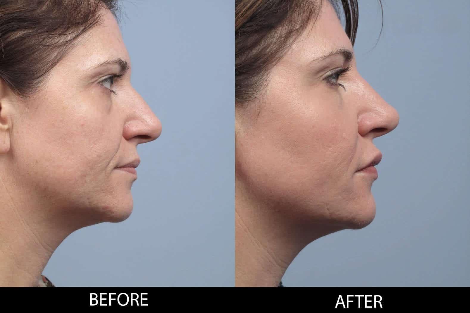 Dermal Fillers Before and After Gallery – Photo 121