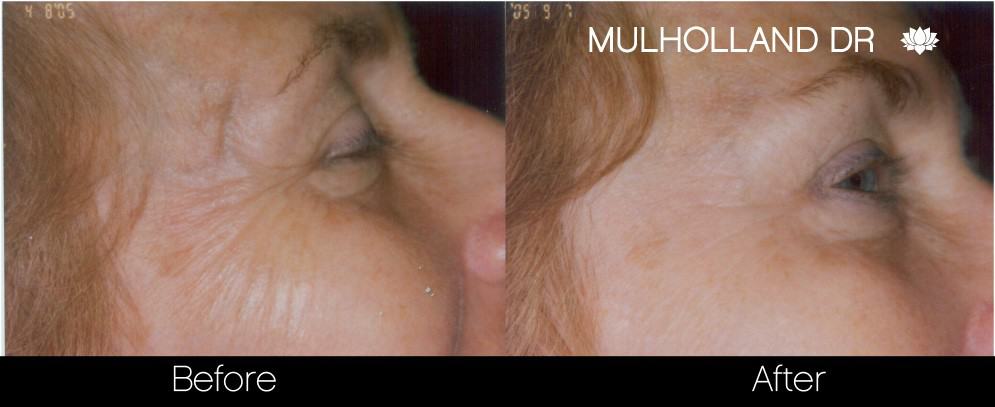 Botox Before and After Gallery - Photo 26