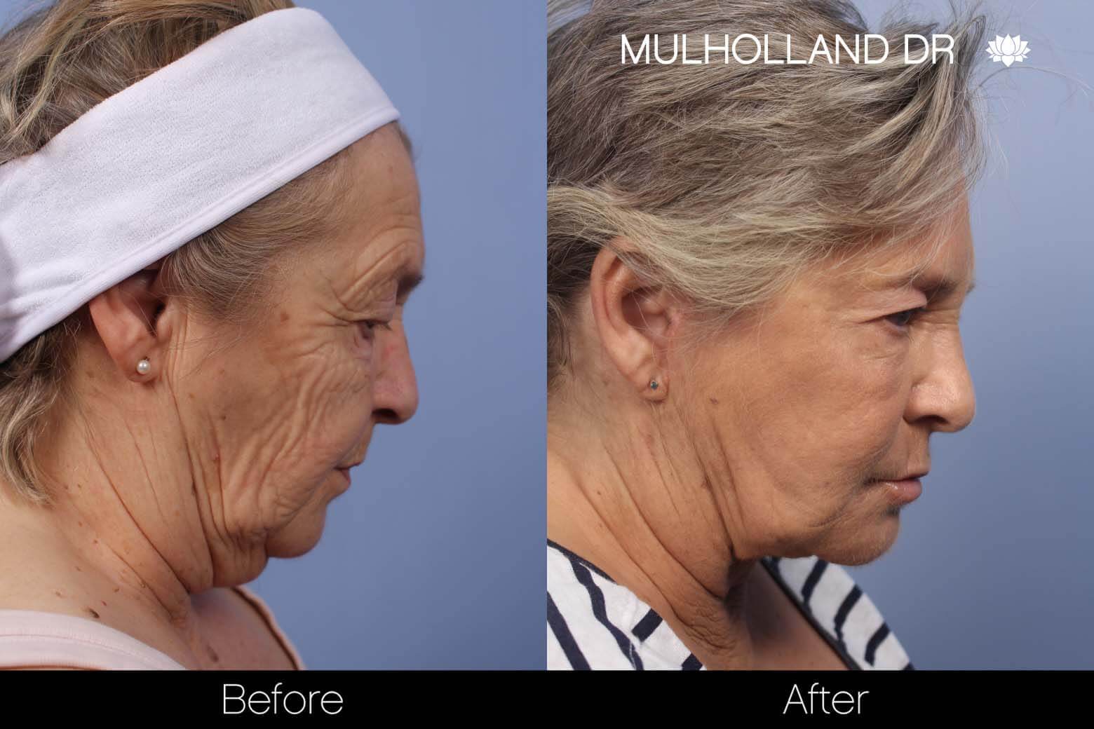FaceTite Before and After Gallery – Photo 4
