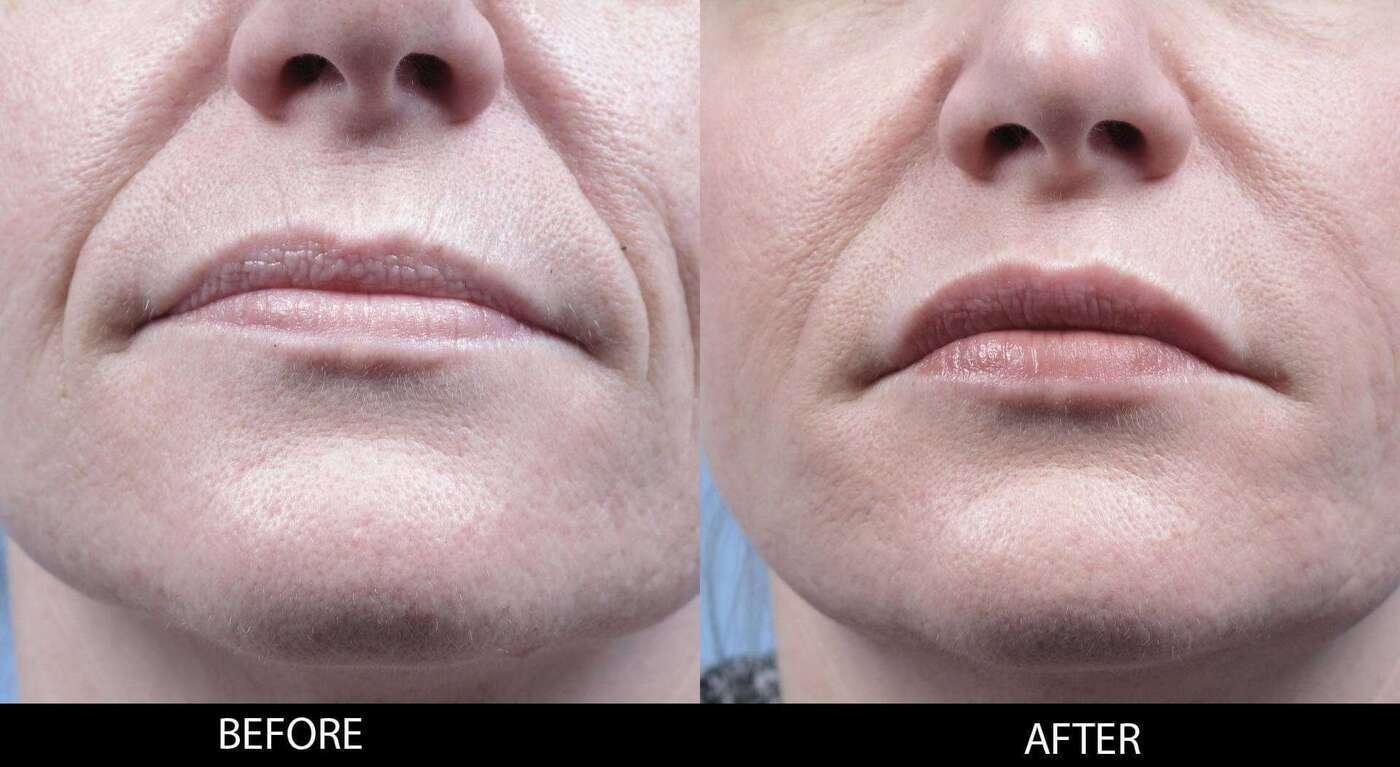 Dermal Fillers Before and After Gallery – Photo 120
