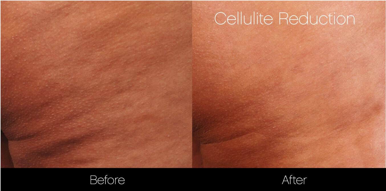 Cellulite Reduction Before and After Gallery – Photo 10