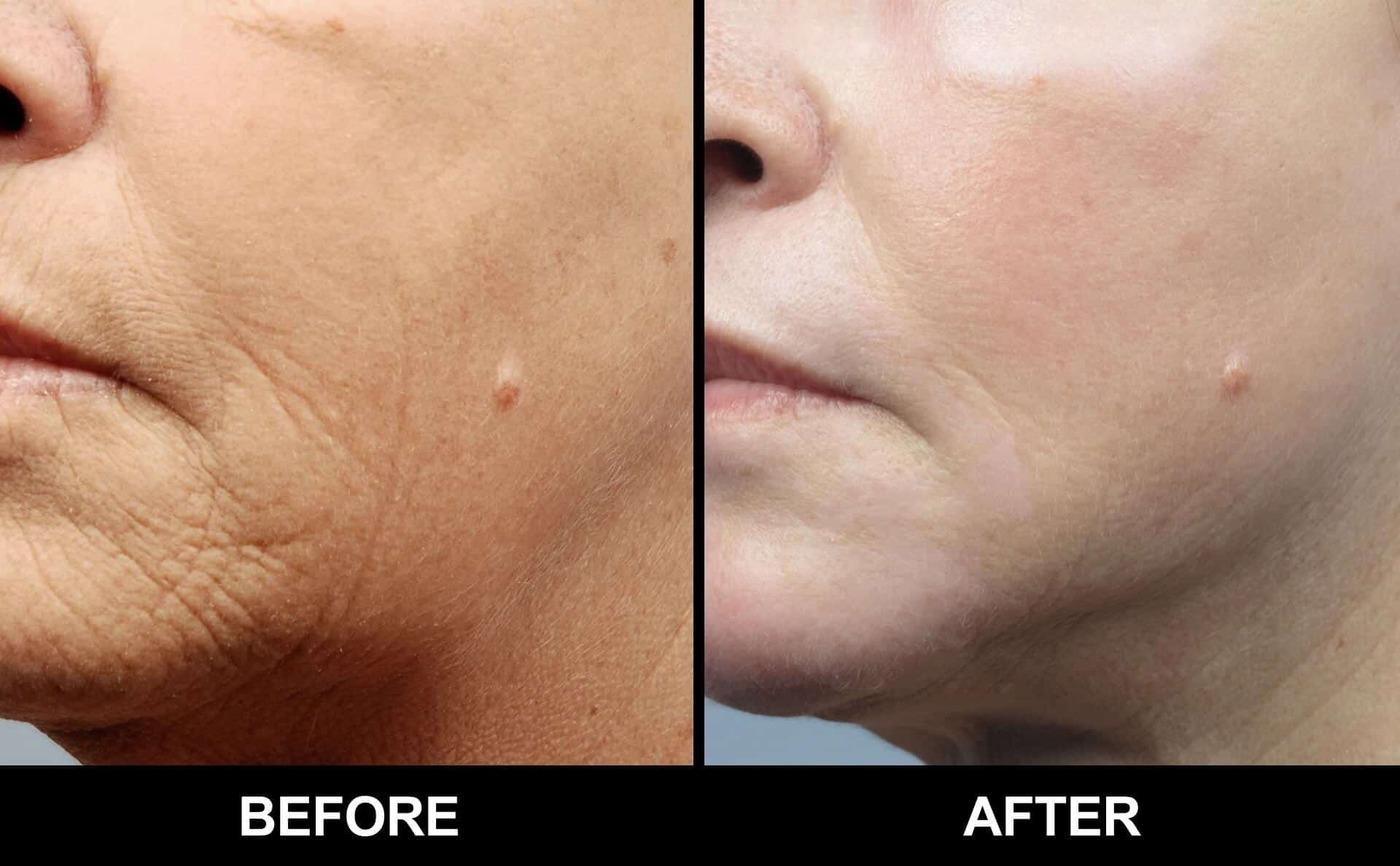 Fractional CO2 Laser Before and After Gallery – Photo 47