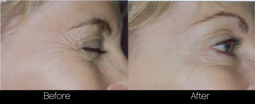 Botox Before and After Gallery - Photo 19