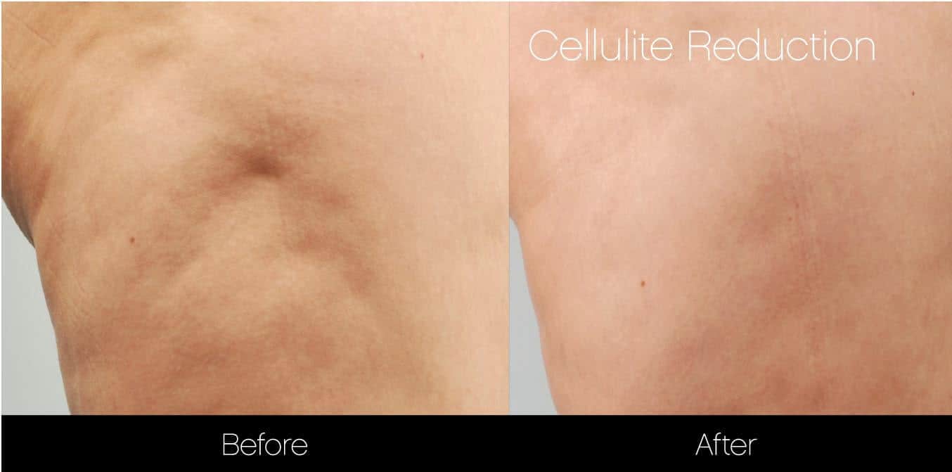 Cellulite Reduction Before and After Gallery – Photo 9