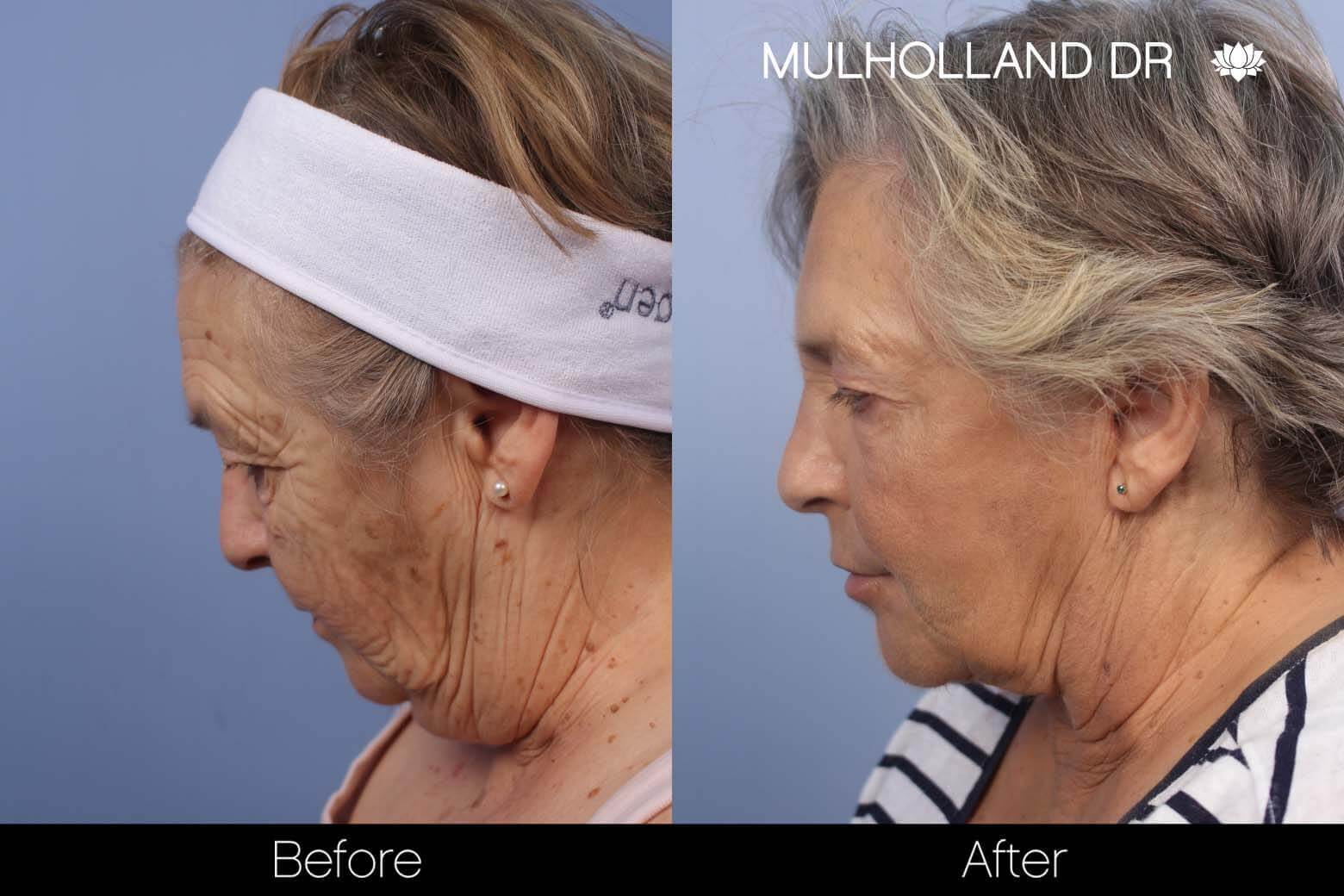 FaceTite Before and After Gallery – Photo 3