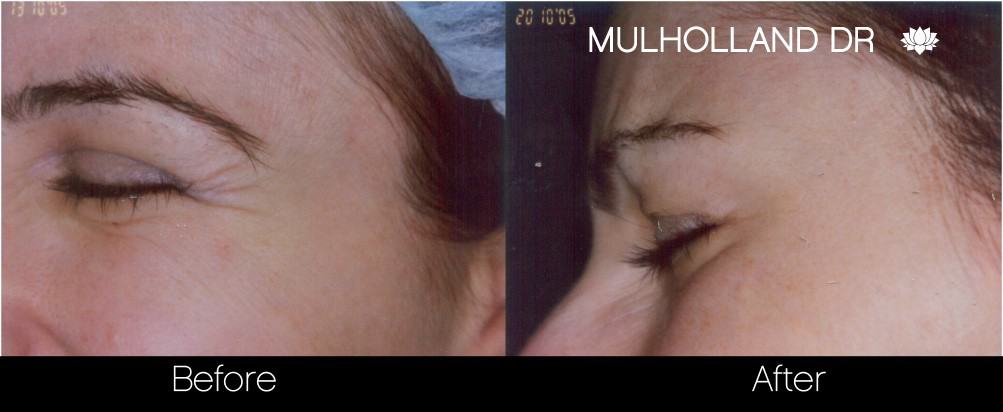 BOTOX® DYSPORT® Borjúváll karcsúsító - Kan Medical Spa - Toronto Beauty Skin Clinic