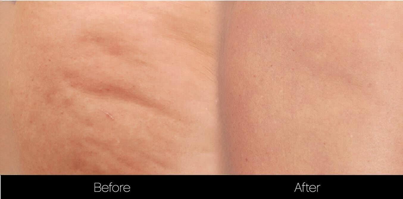 Cellulite Reduction Before and After Gallery – Photo 8