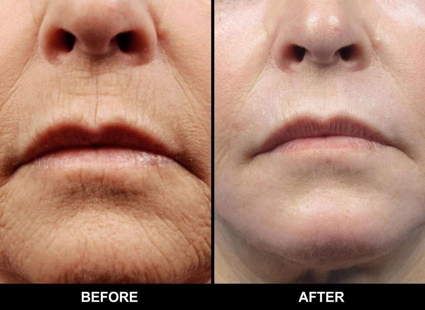 Fractional CO2 Laser Before and After Gallery – Photo 46