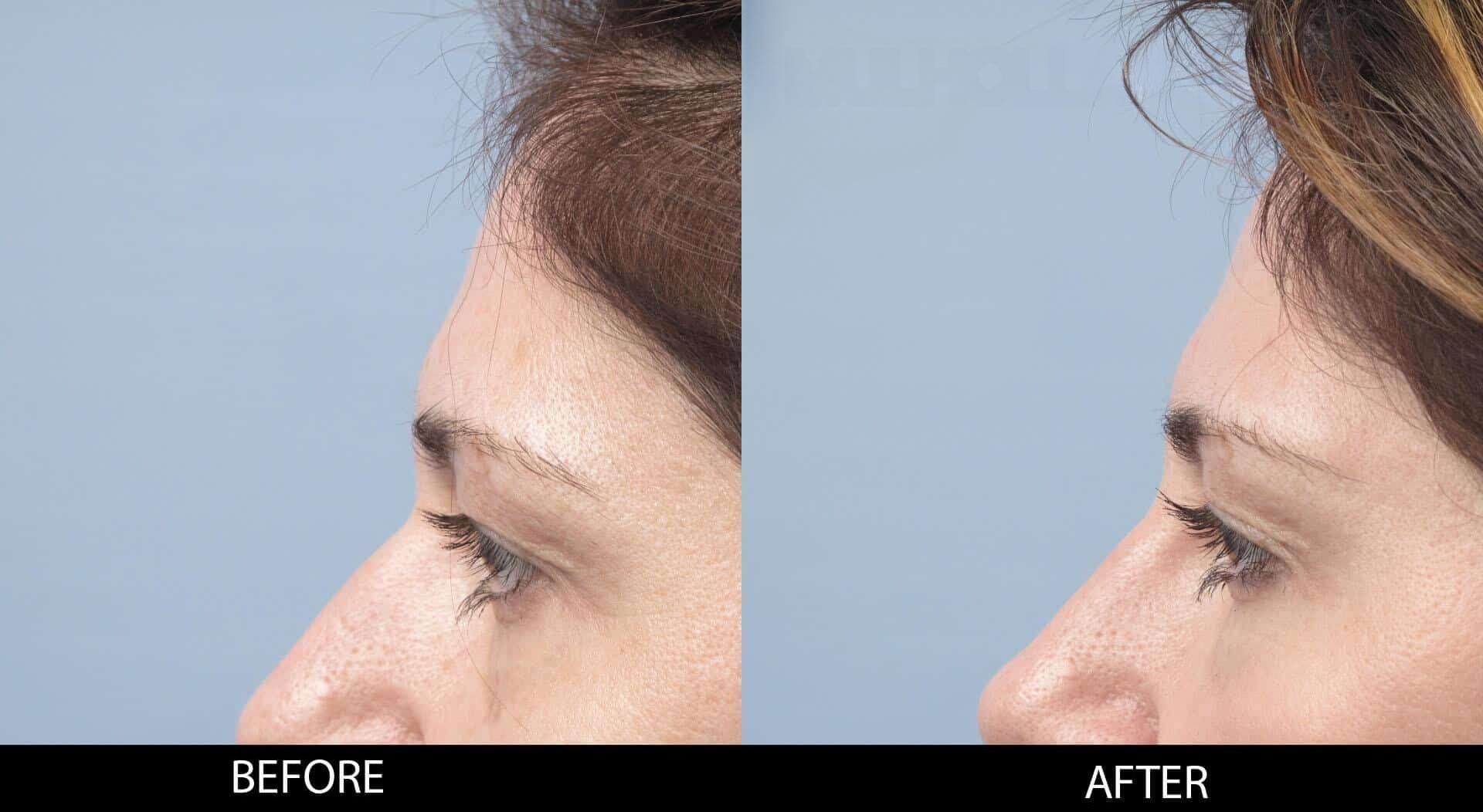 Dermal Fillers Before and After Gallery – Photo 118