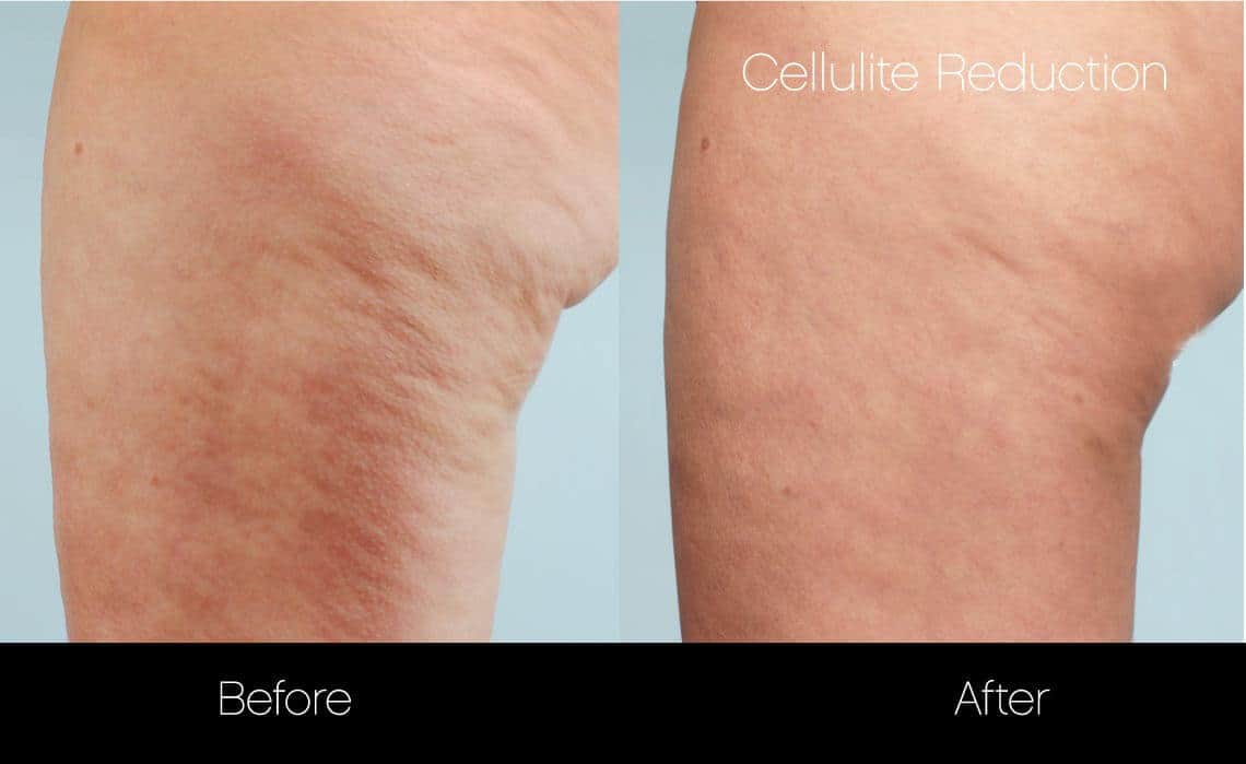 Cellulite Reduction Before and After Gallery – Photo 7
