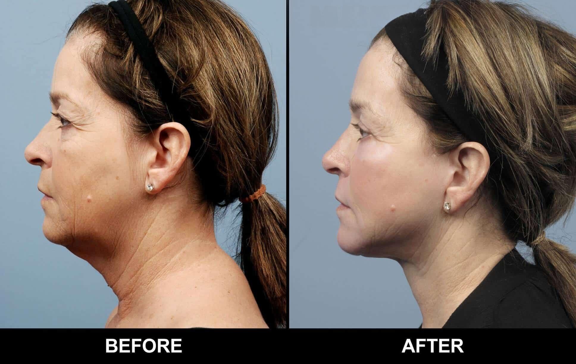 Fractional CO2 Laser Before and After Gallery – Photo 45