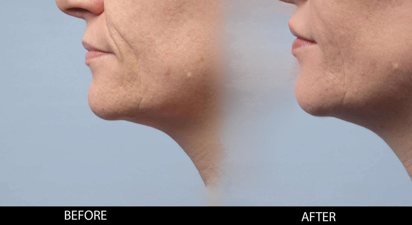 Dermal Fillers Before and After Gallery – Photo 117