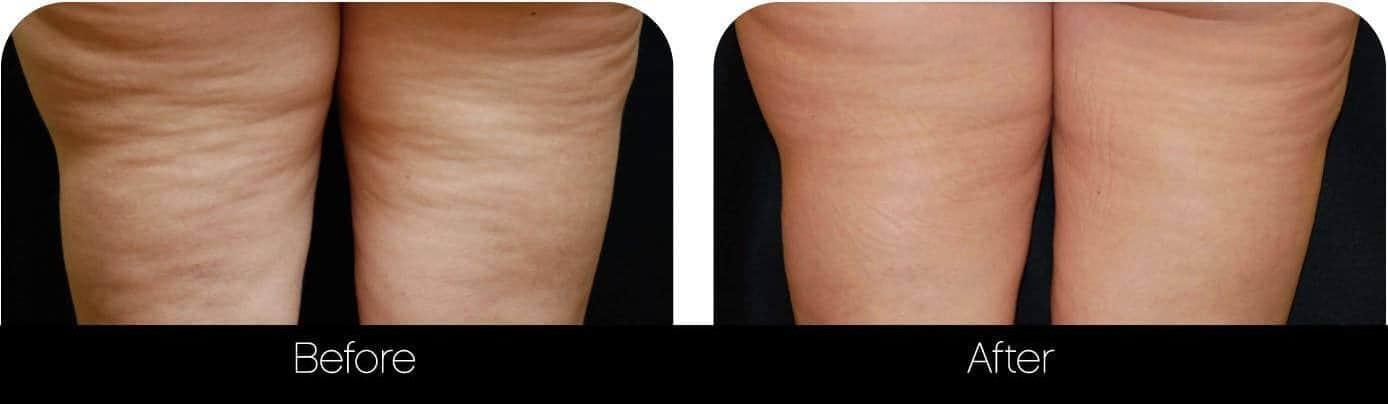 Cellulite Reduction Before and After Gallery – Photo 7