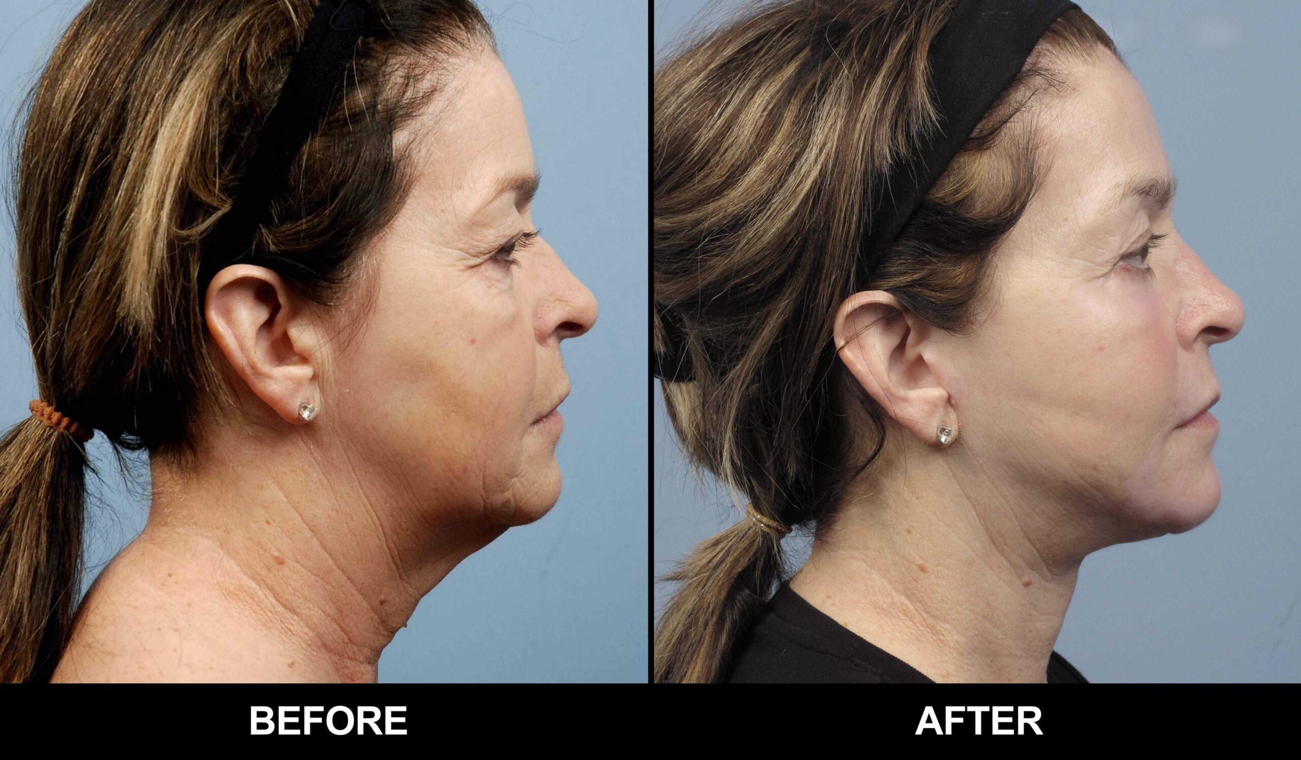 Fractional CO2 Laser Before and After Gallery – Photo 44