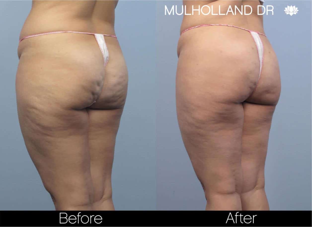 Cellulite Reduction Before and After Gallery – Photo 47