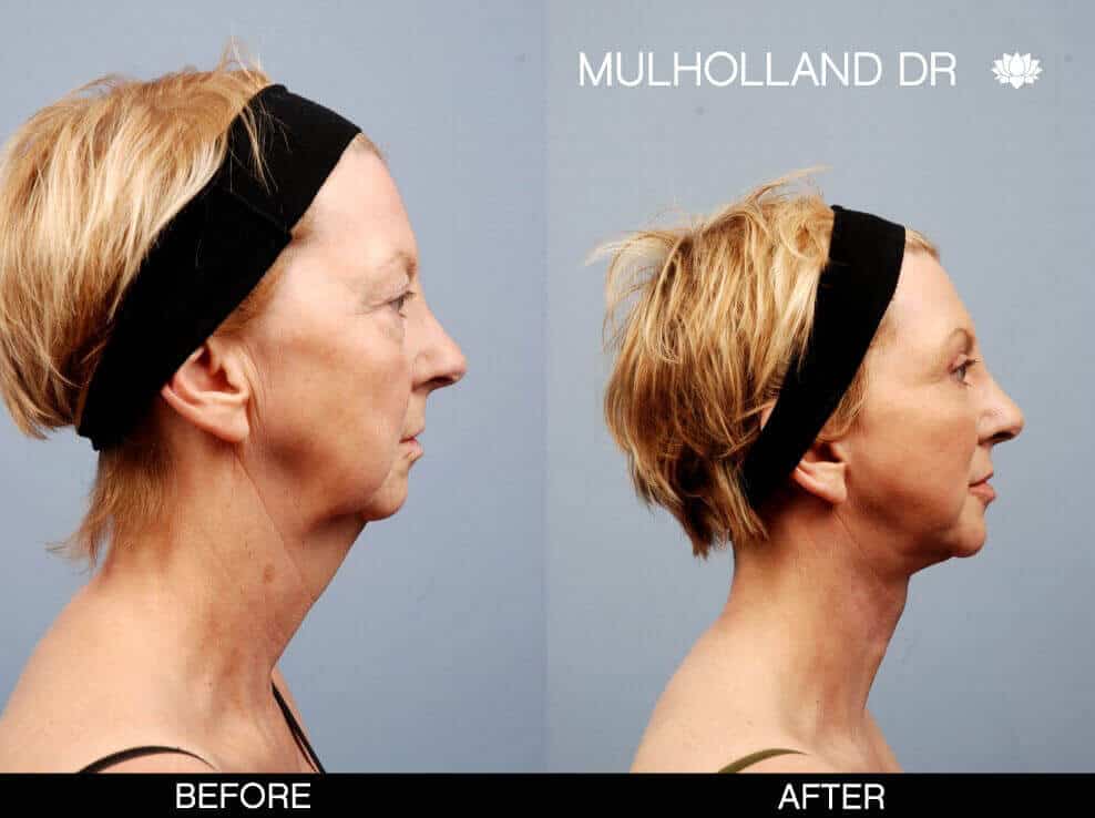FaceTite Before and After Gallery – Photo 26