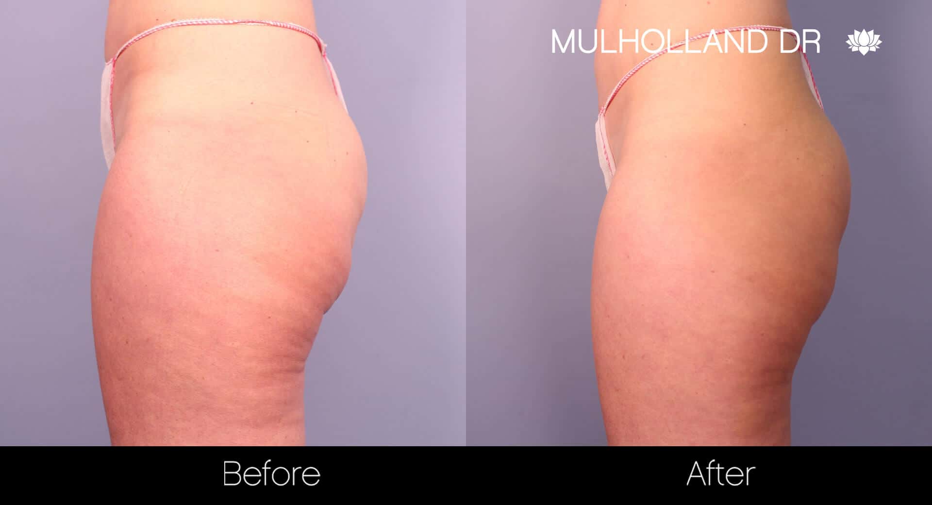 Cellfina Cellulite Treatment - Before and After Gallery – Photo 3