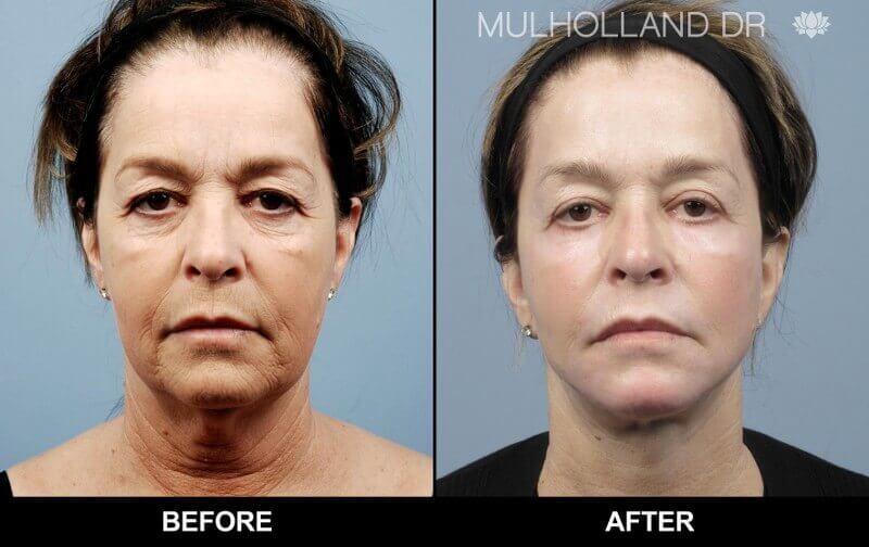 AccuTite Before and After Gallery – Photo 26