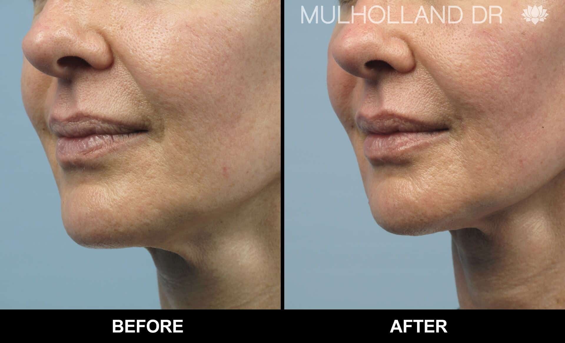 Dermal Fillers Before and After Gallery – Photo 141