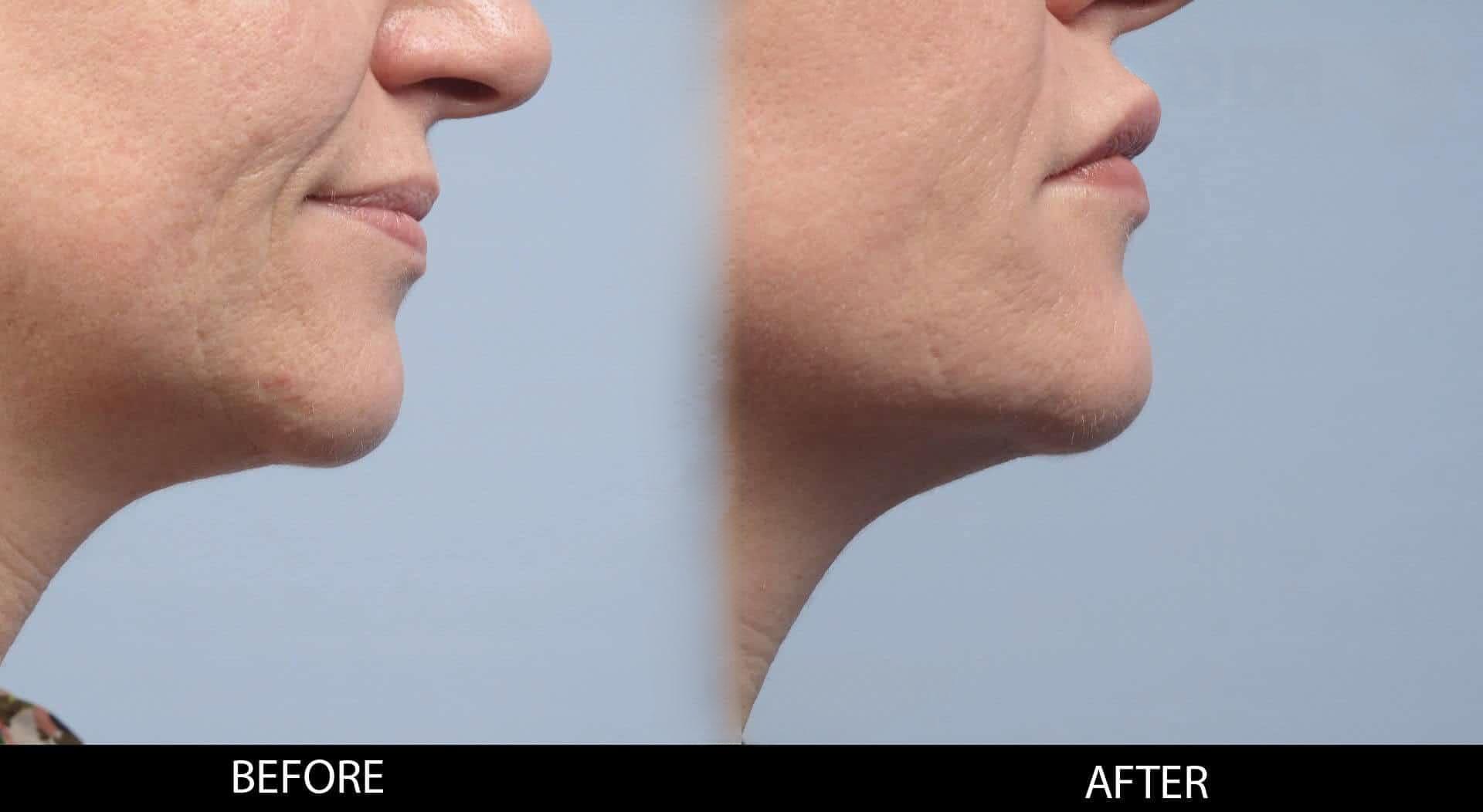 Dermal Fillers Before and After Gallery – Photo 116