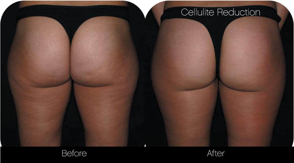 Cellulite Reduction Before and After Gallery – Photo 6