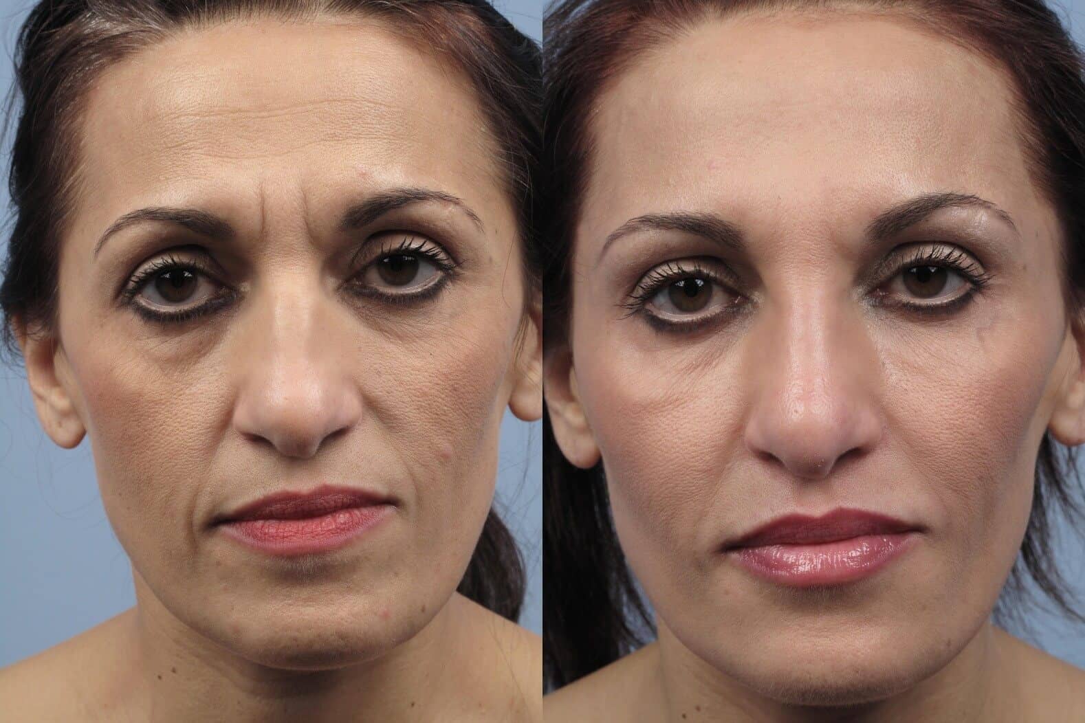 Dermal Fillers Before and After Gallery – Photo 115