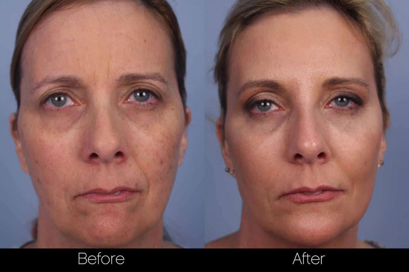 Fractional CO2 Laser Patient 4 Spamedica