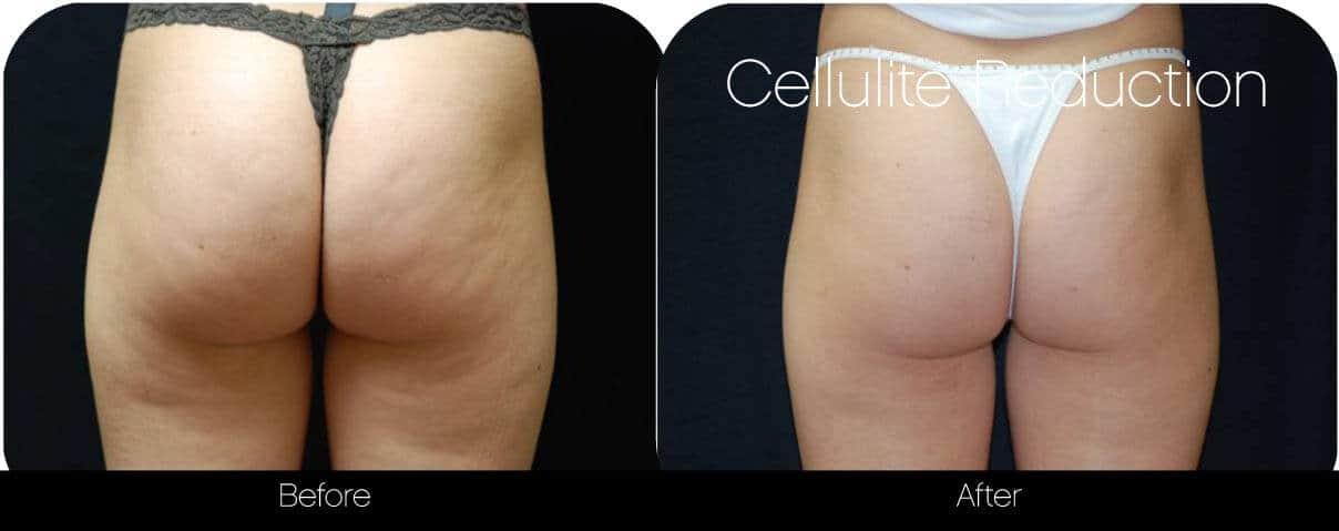 Cellulite Reduction Before and After Gallery – Photo 3