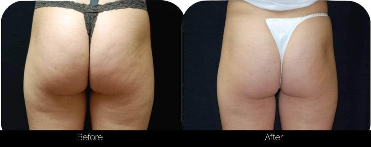 Cellulite Reduction Before and After Gallery – Photo 3