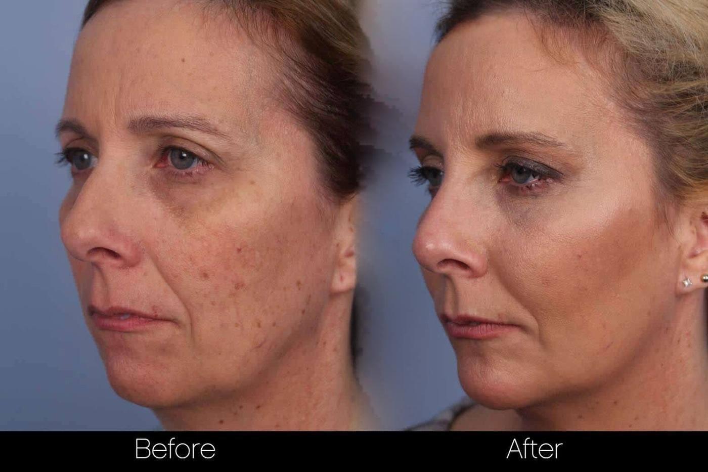 Fractional CO2 Laser Before and After Gallery – Photo 40