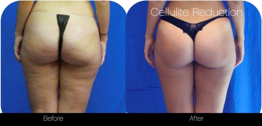 Cellulite Reduction Before and After Gallery – Photo 2